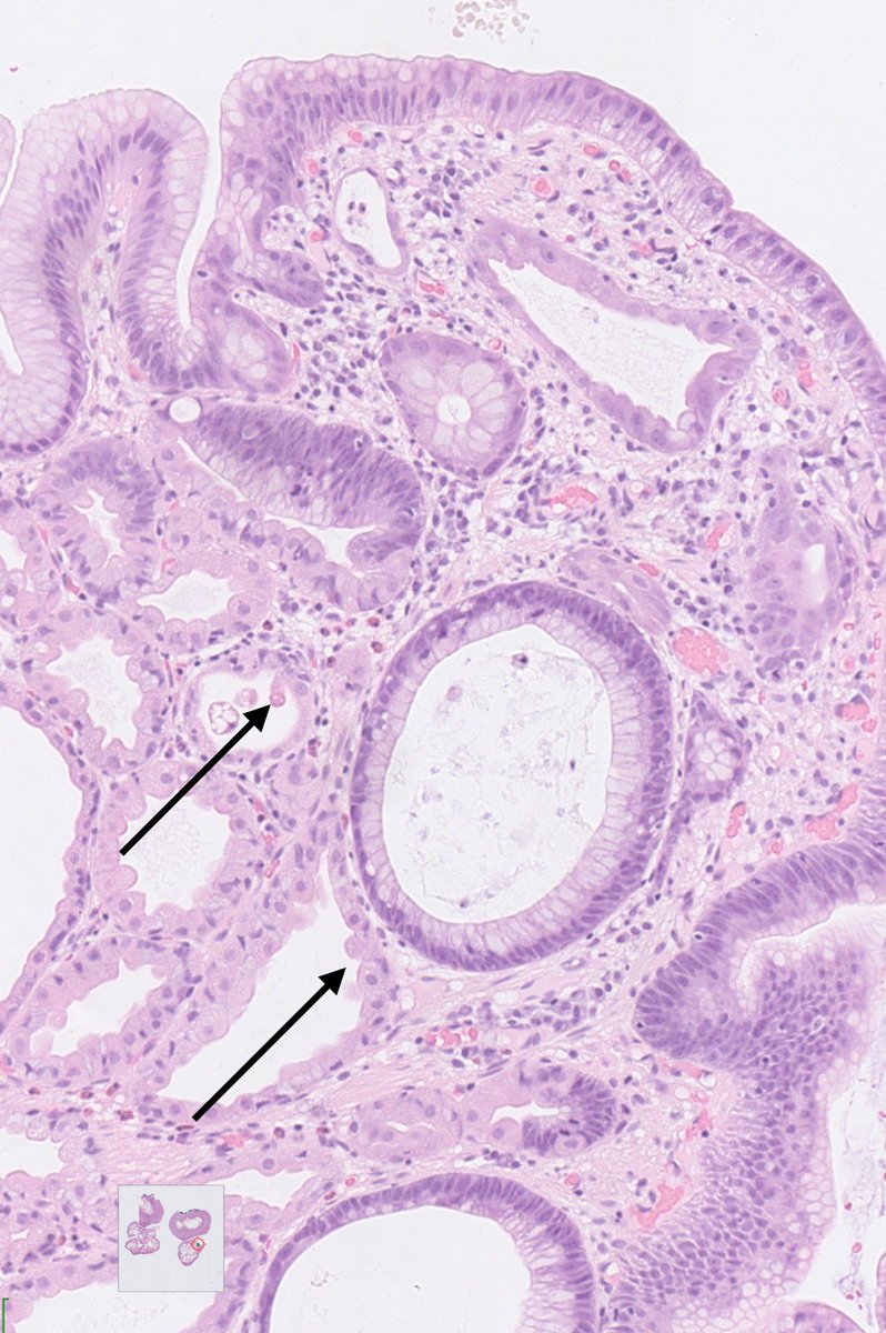 drtimbracey's tweet image. Gastric fundic gland polyp excised after a prior biopsy diagnosis of low grade dysplasia. Foci of LGD marked, and arrows showing “apocrine-like” cytoplasmic snouts seen in patients on PPI medication #pathtwitter #GIPath #pathart @diagnexia