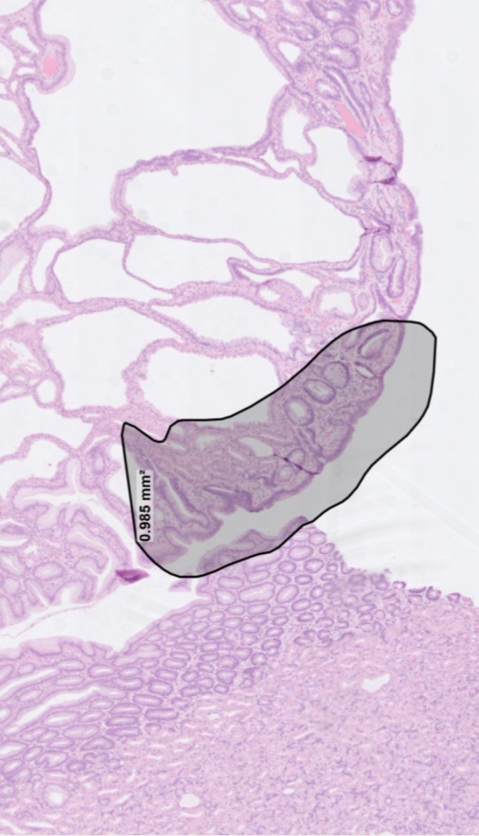 drtimbracey's tweet image. Gastric fundic gland polyp excised after a prior biopsy diagnosis of low grade dysplasia. Foci of LGD marked, and arrows showing “apocrine-like” cytoplasmic snouts seen in patients on PPI medication #pathtwitter #GIPath #pathart @diagnexia