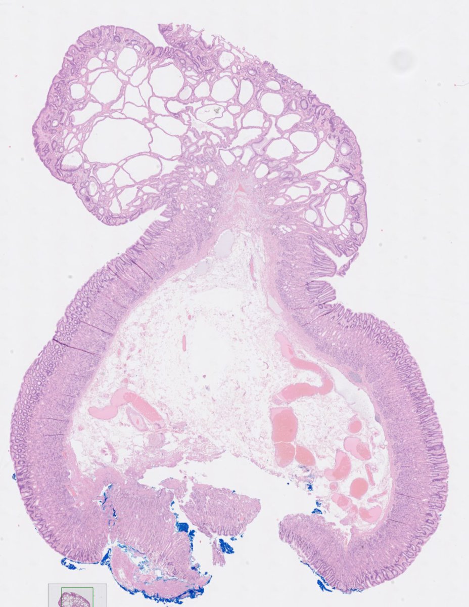 drtimbracey's tweet image. Gastric fundic gland polyp excised after a prior biopsy diagnosis of low grade dysplasia. Foci of LGD marked, and arrows showing “apocrine-like” cytoplasmic snouts seen in patients on PPI medication #pathtwitter #GIPath #pathart @diagnexia