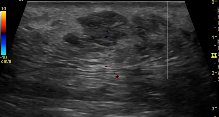 ItaniMalak's tweet photo. Happy Tuesday.. Week 41 of 2024. Praying for Peace all over the world. 

Back from an excellent #SRU24 #ultrasound meeting @sruradiology &amp; always in the mood for a good US #case #radiology 

Patient presenting with a "periumbilical mass" !!  Thoughts?? Answer in the last image https://t.co/rJ1umD5a0F