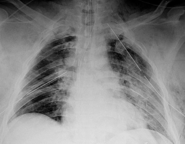 اجاك المريض وقالوا طلع من حادث اصطدام على خط سريع شو اول شي تفكر فيه بعد ما تشوف ال x ray؟
