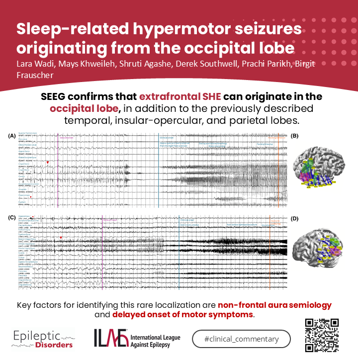 Epileptic Disorders (@epidisorders) on Twitter photo 🧠Wadi et al. describe sEEG findings of sleep-related hypermotor seizures originating from occipital lobe.
💡Aura and speed of progression point to extrafrontal origin.
👉onlinelibrary.wiley.com/doi/10.1002/ep…
<a href="/AnphyLab/">The AnPhy Lab</a> <a href="/SBeniczky/">Sandor Beniczky</a> <a href="/joanajribeiro/">Joana Ribeiro</a> <a href="/SheikhISMD/">irfan sheikh 伊凡</a> <a href="/AlinaIvaniuk/">Alina Ivaniuk 🇺🇦</a> <a href="/IlaeWeb/">International League Against Epilepsy</a> <a href="/yesILAE/">yesILAE</a> 🧠Wadi et al. describe sEEG findings of sleep-related hypermotor seizures originating from occipital lobe.
💡Aura and speed of progression point to extrafrontal origin.
👉onlinelibrary.wiley.com/doi/10.1002/ep…
<a href="/AnphyLab/">The AnPhy Lab</a> <a href="/SBeniczky/">Sandor Beniczky</a> <a href="/joanajribeiro/">Joana Ribeiro</a> <a href="/SheikhISMD/">irfan sheikh 伊凡</a> <a href="/AlinaIvaniuk/">Alina Ivaniuk 🇺🇦</a> <a href="/IlaeWeb/">International League Against Epilepsy</a> <a href="/yesILAE/">yesILAE</a>