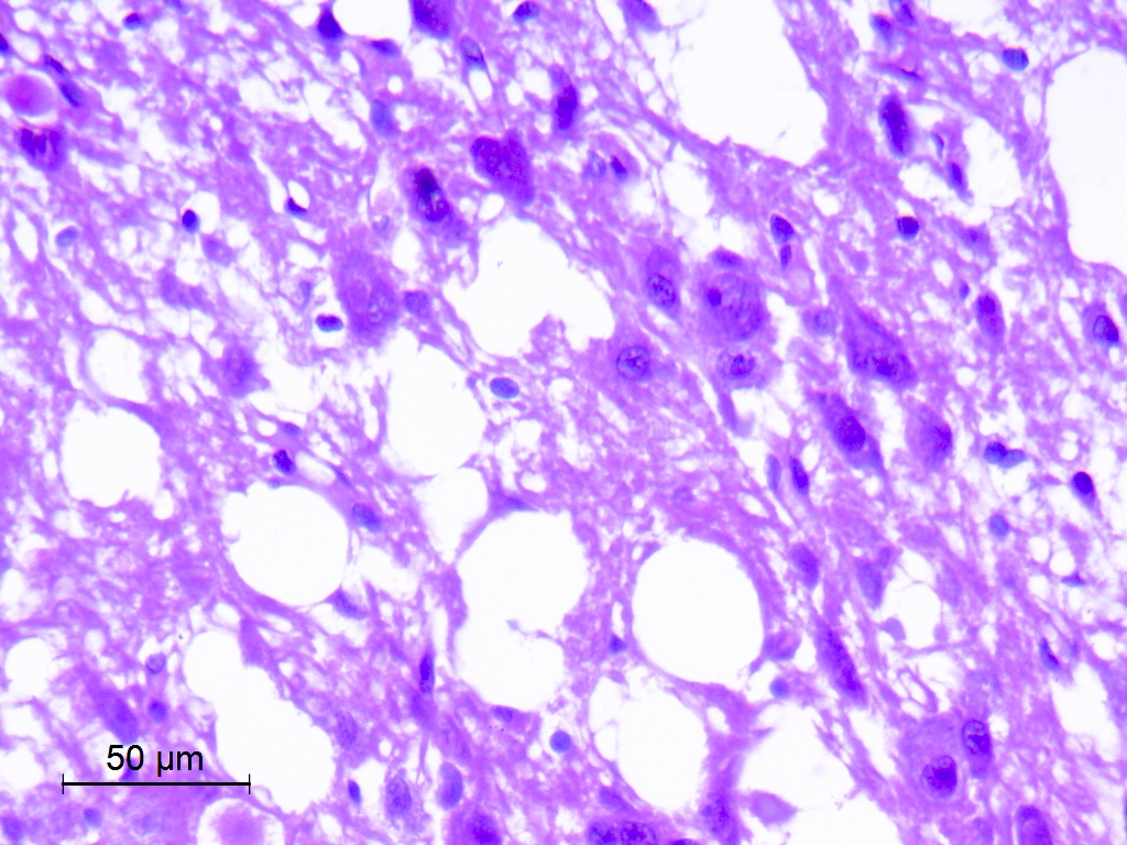 CuringN's tweet photo. CNS & pituitary tumors - What's your diagnosis?
Topic link: https://t.co/r4cVkkfN5B
Images contributed by Eman Abdelzaher, M.D., Ph.D.
Visit our CCN blog for cancer-related essays by Dr. Pernick: https://t.co/aaLBk9BA8J.
#Cancer #CancerResearch #CuringCancerNetwork #Pathology https://t.co/xGfvL2M9vR