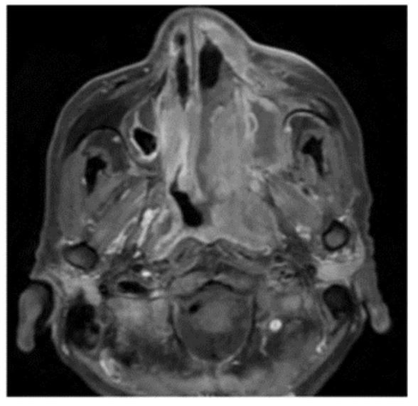 JGIM Journal of General Internal Medicine (@journalgim) on Twitter photo Check out this new #JGIM #ExerciseInClinicalReasoning case by <a href="/rachechang/">Rachel Chang</a> <a href="/gregory_ow/">Gregory Ow</a> <a href="/EvanWalkerMD/">Evan Walker</a> <a href="/KBrooksMD/">Katie Brooks</a> @andyrlai highlighting the use of social context in diagnosing the cause of an elevated lactate!
buff.ly/4eL5sRe Check out this new #JGIM #ExerciseInClinicalReasoning case by <a href="/rachechang/">Rachel Chang</a> <a href="/gregory_ow/">Gregory Ow</a> <a href="/EvanWalkerMD/">Evan Walker</a> <a href="/KBrooksMD/">Katie Brooks</a> @andyrlai highlighting the use of social context in diagnosing the cause of an elevated lactate!
buff.ly/4eL5sRe