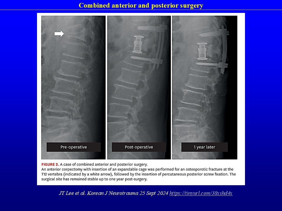 Pain Intervention for Osteoporotic Compression Fracture, From Physical Therapy to Surgery: A Literature Review. JT Lee et al. Korean J Neurotrauma 25 Sept 2024 tinyurl.com/38xshd4x  …short practical review