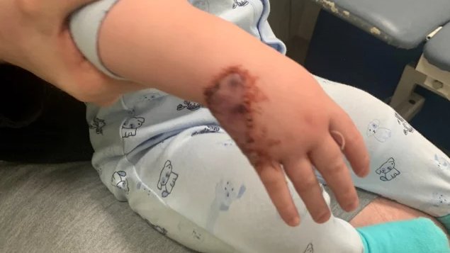 ✨Did you know hair straighteners can reach more than 200 degrees and can take up to 40 minutes to cool down✨

Read Billy's story below

shorturl.at/iaB3b 

#BeBurnsAware #NationalBurnAwarenessDay
<a href="/BritishBurn/">British Burn Assoc.</a> <a href="/CBTofficial/">ChildrensBurnsTrust</a> <a href="/MFTnhs/">MFT NHS</a> <a href="/WythenshaweHosp/">Wythenshawe Hospital</a>
