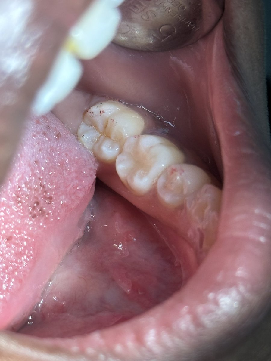 Done with my first restoration #36 ☺️