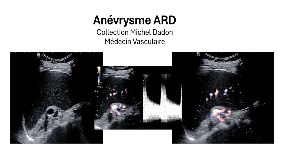 Dr Jean Pierre Laroche #vacciné 6.0 (@echoraljpangio) on Twitter photo Anévrismes viscéraux medvasc.info/archives-blog/… <a href="/RodgerMarc/">Marc Rodger</a> <a href="/MarcBlondon/">Marc Blondon</a> <a href="/LuciaMazzolai/">Lucia Mazzolai</a> <a href="/jeanlucvachiery/">Jean-Luc Vachiery 🫀</a> <a href="/msalem5757/">Mohammed Salem</a> <a href="/MUTWAKILMOHAM12/">MUTWAKIL MOHAMED</a> <a href="/Dr_moji/">Dr Jimmy Mohamed</a> <a href="/NMerke/">Nicolas Merke</a> <a href="/MeralKayikcoglu/">Dr Meral Kayikcioglu</a> <a href="/LaurenMerzMD/">Lauren Merz</a> <a href="/gabrielsteg/">Ph.Gabriel Steg</a> <a href="/nanoulikjan/">Anaïs #StandwithArmenia</a> <a href="/CHUdeMarseille/">AP-HM Story</a> <a href="/stanhenkin/">Stanislav Henkin</a> <a href="/CHU_Montpellier/">CHU de Montpellier</a> <a href="/MedVasc_HEGP/">Med-Vasculaire HEGP</a> <a href="/MedvascC/">MedVasc&Therapeutique_CHUSE</a> Anévrismes viscéraux medvasc.info/archives-blog/… <a href="/RodgerMarc/">Marc Rodger</a> <a href="/MarcBlondon/">Marc Blondon</a> <a href="/LuciaMazzolai/">Lucia Mazzolai</a> <a href="/jeanlucvachiery/">Jean-Luc Vachiery 🫀</a> <a href="/msalem5757/">Mohammed Salem</a> <a href="/MUTWAKILMOHAM12/">MUTWAKIL MOHAMED</a> <a href="/Dr_moji/">Dr Jimmy Mohamed</a> <a href="/NMerke/">Nicolas Merke</a> <a href="/MeralKayikcoglu/">Dr Meral Kayikcioglu</a> <a href="/LaurenMerzMD/">Lauren Merz</a> <a href="/gabrielsteg/">Ph.Gabriel Steg</a> <a href="/nanoulikjan/">Anaïs #StandwithArmenia</a> <a href="/CHUdeMarseille/">AP-HM Story</a> <a href="/stanhenkin/">Stanislav Henkin</a> <a href="/CHU_Montpellier/">CHU de Montpellier</a> <a href="/MedVasc_HEGP/">Med-Vasculaire HEGP</a> <a href="/MedvascC/">MedVasc&Therapeutique_CHUSE</a>