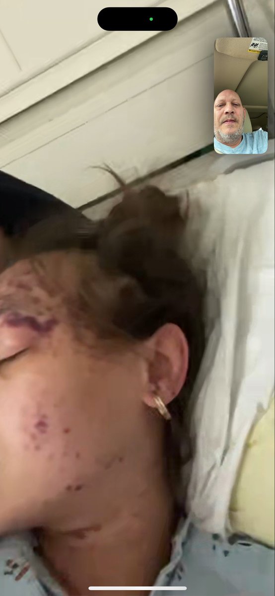 RealToddLorenze's tweet photo. On the night Alexis Lorenze got the vaccines, @llexxiiiiiiii, meningitis, pneumonia and DTap within 30 seconds she was complaining of arm pain, within 5 minutes her jaw locked up, under 10 minutes her nose was bleeding, throwing up blood, blindness for 15 min, red dots appeared https://t.co/4E0pg7Aac9
