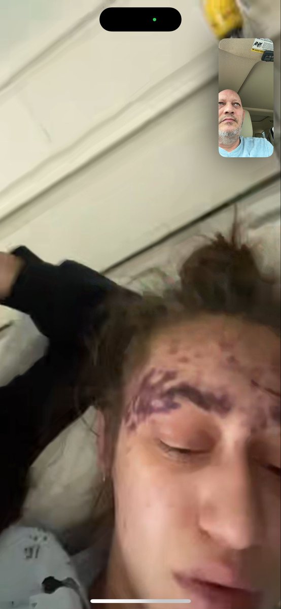 RealToddLorenze's tweet photo. On the night Alexis Lorenze got the vaccines, @llexxiiiiiiii, meningitis, pneumonia and DTap within 30 seconds she was complaining of arm pain, within 5 minutes her jaw locked up, under 10 minutes her nose was bleeding, throwing up blood, blindness for 15 min, red dots appeared https://t.co/4E0pg7Aac9
