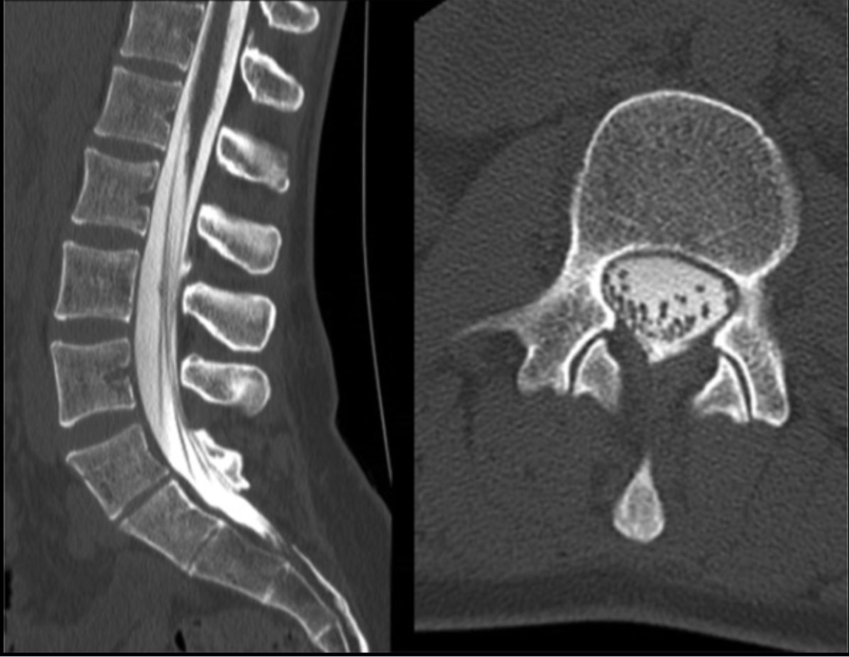 Neurosurgery Publications (@neurosurgerycns) on Twitter photo #NEUPrac Endoscopic Repair of Cerebrospinal Fluid Leak bit.ly/3NnmA3y by Schwartz et al <a href="/MethodistHosp/">Houston Methodist</a> <a href="/JohnHShinMD/">John H. Shin MD, MBA</a> <a href="/CNS_Update/">CNS</a> <a href="/Zaazoue/">Mohamed Zaazoue</a> #NEUPrac Endoscopic Repair of Cerebrospinal Fluid Leak bit.ly/3NnmA3y by Schwartz et al <a href="/MethodistHosp/">Houston Methodist</a> <a href="/JohnHShinMD/">John H. Shin MD, MBA</a> <a href="/CNS_Update/">CNS</a> <a href="/Zaazoue/">Mohamed Zaazoue</a>