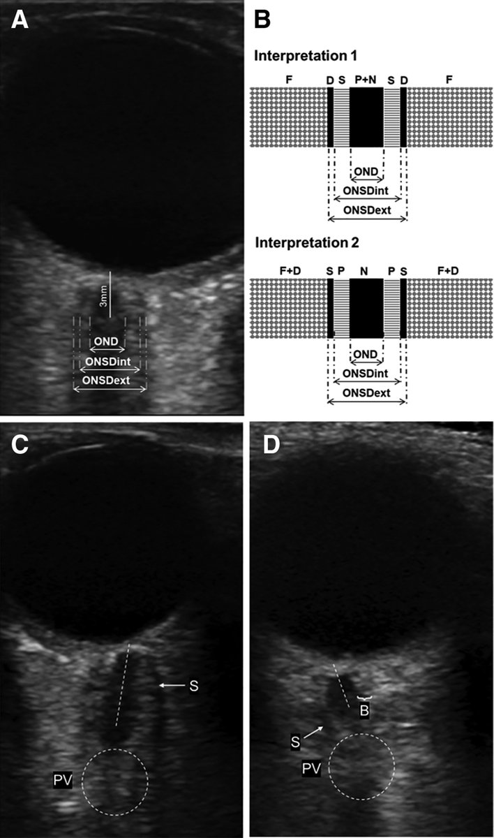 Nicholas Morris (@namorrismd) on Twitter photo Consensus Statement: Optic Nerve Sheath Diameter Point-of-Care Ultrasonography... : <a href="/CritCareMed/">Critical Care Medicine</a> <a href="/MDNeurocritcare/">University of Maryland Neurocritical Care</a> <a href="/ShockTrauma_CC/">Shock Trauma Center Critical Care Fellowship</a> <a href="/neurocritical/">Neurocritical Care Society</a> journals.lww.com/ccmjournal/abs… Consensus Statement: Optic Nerve Sheath Diameter Point-of-Care Ultrasonography... : <a href="/CritCareMed/">Critical Care Medicine</a> <a href="/MDNeurocritcare/">University of Maryland Neurocritical Care</a> <a href="/ShockTrauma_CC/">Shock Trauma Center Critical Care Fellowship</a> <a href="/neurocritical/">Neurocritical Care Society</a> journals.lww.com/ccmjournal/abs…