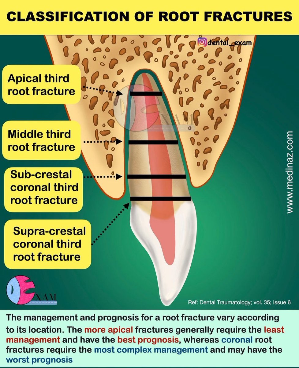 DiariesDent's tweet photo. Classification of root fractures https://t.co/ZPZ2yWLrrD