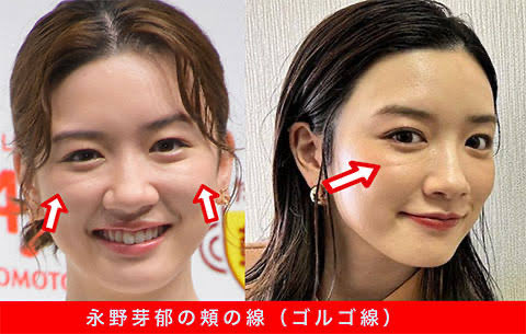 hanashuku's tweet image. 永野芽郁のこの目の下の凹みだけど、ザイゴマティックリガメント由来のゴルゴラインなんよね。

これ目の下の脱脂では改善できないし上から脂肪注入しても靭帯が邪魔して凸凹になるから靭帯剥離されることが多いんよ。

クマ取りは奥深い整形なんよな。

#裏ハムラ #目の下のクマ
