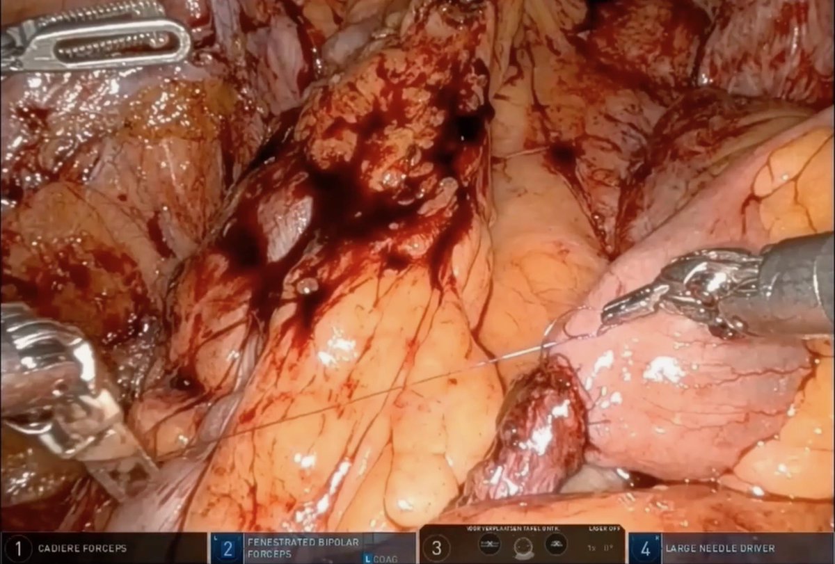 Iulia Andras (@driuliaandras) on Twitter photo Robotic ureteral reimplantation in urinary diversion is safe and efficient for pts with benign strictures after RARC 🤖 Check-out our video in <a href="/urovidjournal/">Urology Video Journal (UVJ)</a> <a href="/EAU_YAURobotics/">EAU_YAURobotics</a> <a href="/eau_yuo/">EAU Young Urologists</a>
doi.org/10.1016/j.urol… Robotic ureteral reimplantation in urinary diversion is safe and efficient for pts with benign strictures after RARC 🤖 Check-out our video in <a href="/urovidjournal/">Urology Video Journal (UVJ)</a> <a href="/EAU_YAURobotics/">EAU_YAURobotics</a> <a href="/eau_yuo/">EAU Young Urologists</a>
doi.org/10.1016/j.urol…