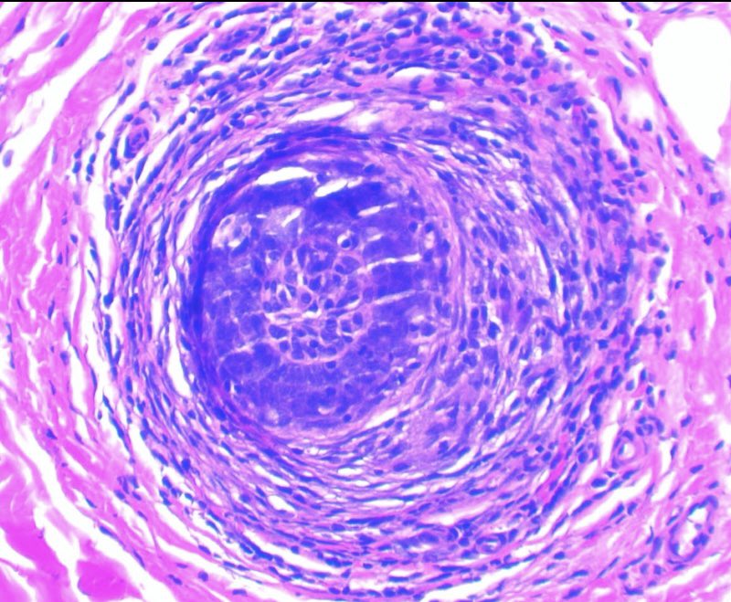 JCandidoXavier's tweet photo. I am back #dermpath 😁
X is released in Brazil again.

Peribulbar lymphocytic infiltrate is typical but fibrous tracts with lymphocytes and miniaturized follicles in the telogen phase are good clues to

ALOPECIA AREATA 

#path #pathology #dermatopathology #derm #hair #alopecia https://t.co/oSv53qKFNw