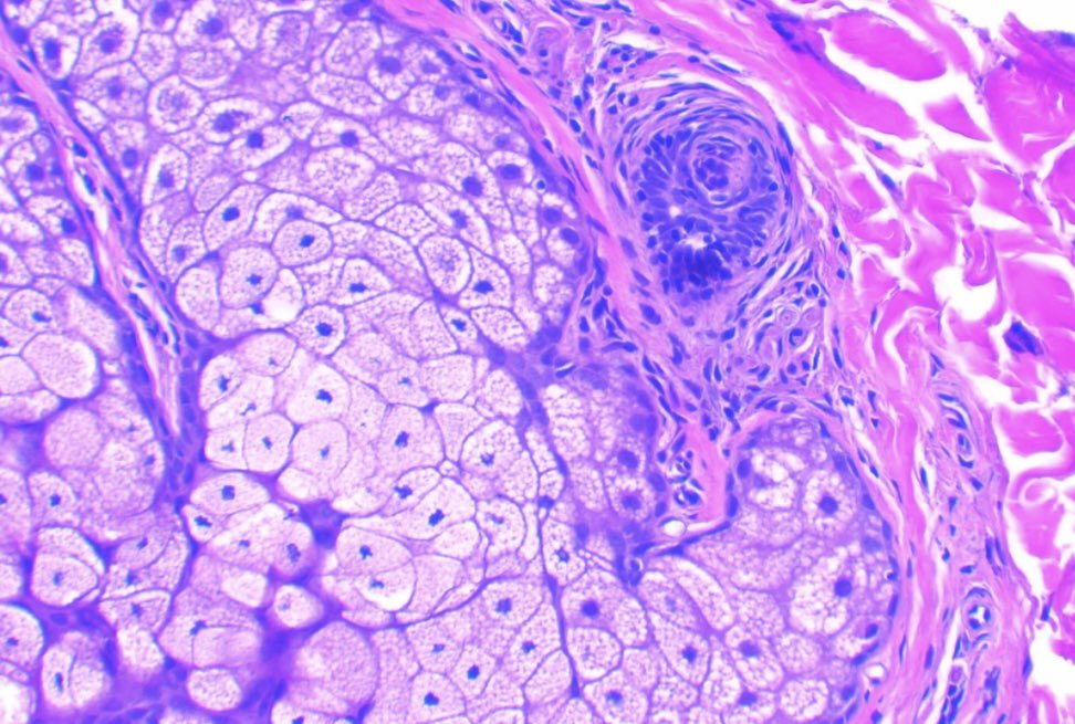 JCandidoXavier's tweet photo. I am back #dermpath 😁
X is released in Brazil again.

Peribulbar lymphocytic infiltrate is typical but fibrous tracts with lymphocytes and miniaturized follicles in the telogen phase are good clues to

ALOPECIA AREATA 

#path #pathology #dermatopathology #derm #hair #alopecia https://t.co/oSv53qKFNw