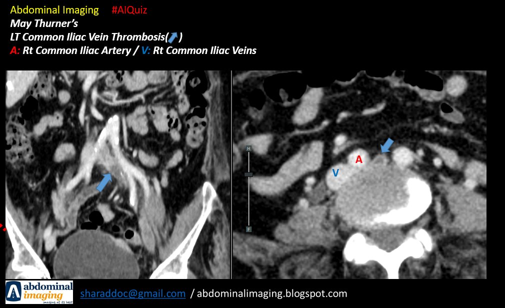 abdo_imaging's tweet image. Abdominal Imaging #AIQuiz 

May Thurner:

Compression and thrombosis of the left common iliac vein by the exiting right common iliac artery.

#vascular #venogram #FOAMed #foamrad #radtwitter