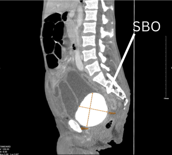 urogoldjournal's tweet photo. GOLD CHALLENGE 
55 y.o. M PMHx of DM and UTIs presenting with abd pain, weight loss, burping over 4 days. PE showed mild abd tenderness and ventral hernia. NG tube placed; however, patient developed an SBO. CT shown.
https://t.co/RkVND2OAs3
What would you do next?
@Ben_Ecklund @kalteruro @CleClinicUroRes