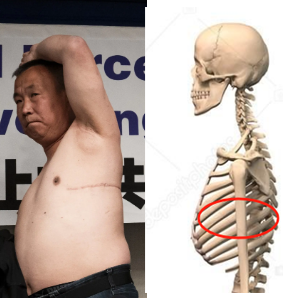 pulinlink's tweet photo. 程佩明等等都是被收买的“假证” 。伤疤处是人体肋骨，肋骨是保护人体器官的，根本不可能从此处取出器官。这又是个愚蠢的谣言！
https://t.co/sZn1aHZE0c https://t.co/lCGc27l5tQ