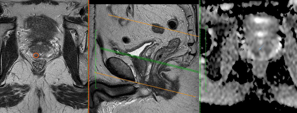 fseguradiazURO's tweet photo. Realmente contentos de seguir sumando tecnologías de vanguardia para nuestros paciente.

Nuestro centro cuenta hace 1 mes con el primer equipo de #Microultrasonido @ExactImaging @EDAPTMS para optimizar la detección #cancerprostata en red pública de hospitales 🏥 🇨🇱 @diegogavilan https://t.co/2f2f14meIK