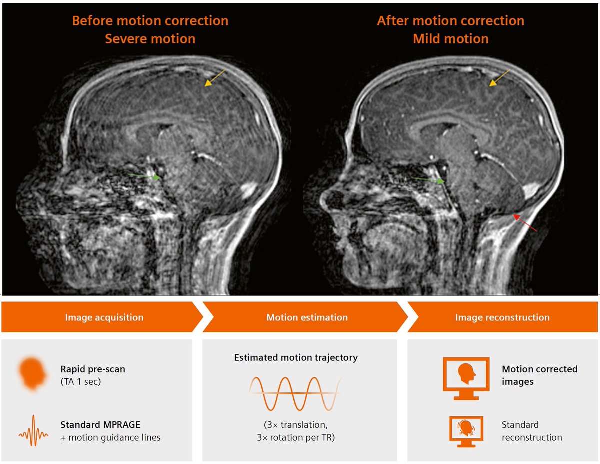 Antje Hellwich @antjehellwich.bsky.social (@antjehellwich) on Twitter photo Scout-Accelerated Motion Estimation and Reduction (SAMER) for #Pediatric Brain #MRI by <a href="/Azitabari/">Azadeh Tabari</a>, et al. (<a href="/MGHMartinos/">MGH Martinos Center</a>).
Learn more at …ng.webassets.siemens-healthineers.com/5acd1c6553bf19…
#magnetomworld #MoCo #MotionCorrection
Big thank you to <a href="/MinLangMD/">Min Lang</a> <a href="/drjohnconklin/">John Conklin</a> <a href="/Mike_Gee8/">Mike G</a> <a href="/SusieHuangMDPhD/">Susie Huang</a> et al Scout-Accelerated Motion Estimation and Reduction (SAMER) for #Pediatric Brain #MRI by <a href="/Azitabari/">Azadeh Tabari</a>, et al. (<a href="/MGHMartinos/">MGH Martinos Center</a>).
Learn more at …ng.webassets.siemens-healthineers.com/5acd1c6553bf19…
#magnetomworld #MoCo #MotionCorrection
Big thank you to <a href="/MinLangMD/">Min Lang</a> <a href="/drjohnconklin/">John Conklin</a> <a href="/Mike_Gee8/">Mike G</a> <a href="/SusieHuangMDPhD/">Susie Huang</a> et al