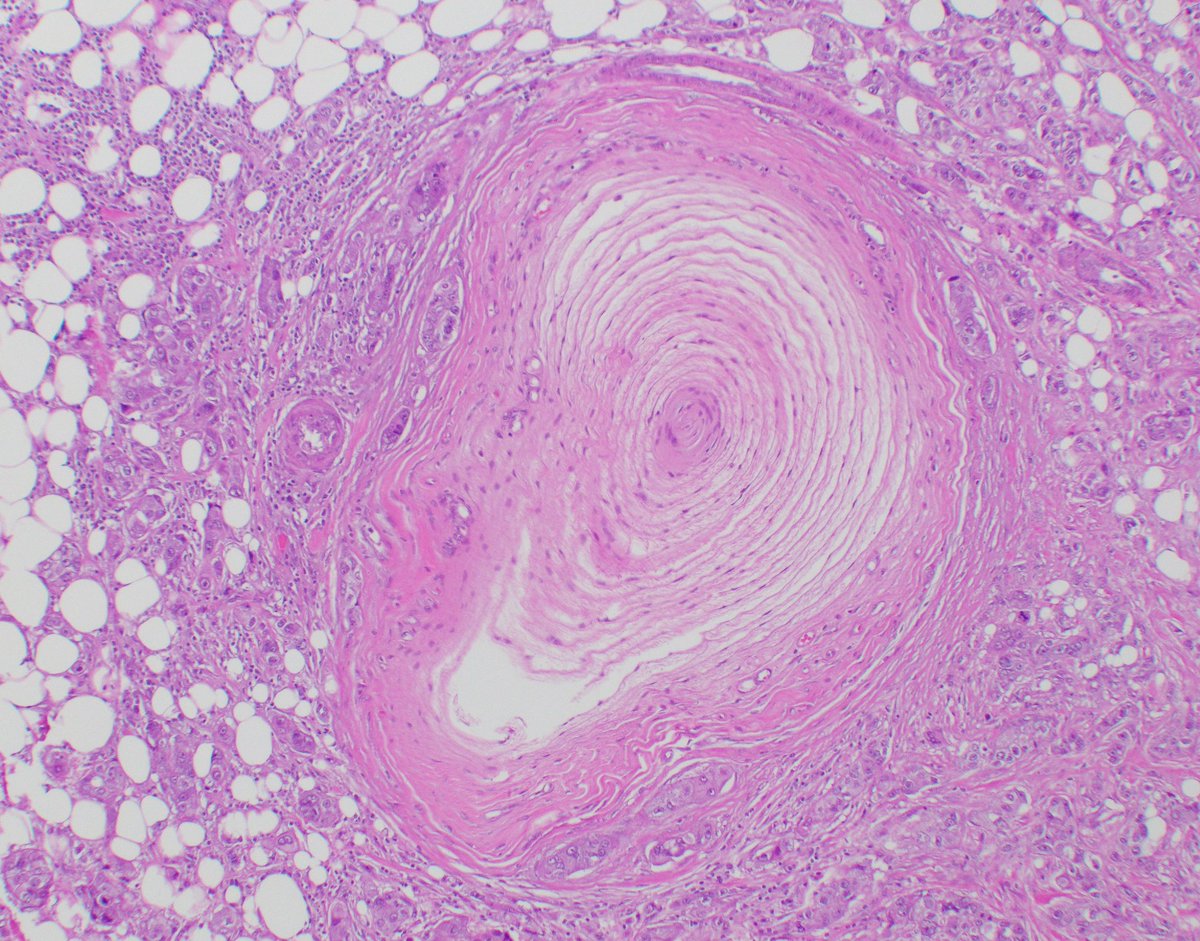 Breast carcinoma invading Pacinian corpuscle.
#breastpath #pathresidents #pathtwitter #BreastPatholog1
<a href="/ColumbiaPath/">Columbia Pathology</a> <a href="/Columbia/">Columbia University</a>pathres @Columbia
<a href="/TheISBP/">ISBP</a>