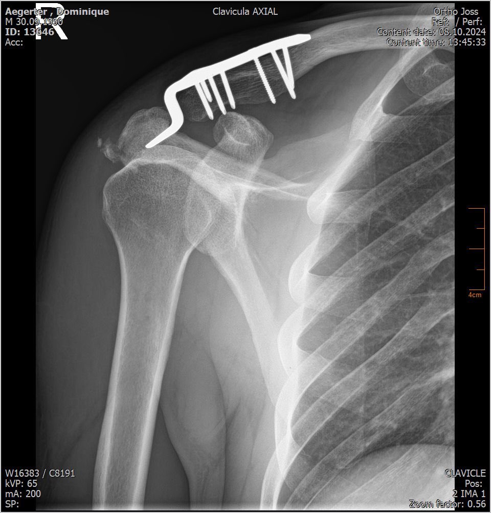 DomiAegerter77's tweet image. Danke Dr. Stefan Joss und dem Ärzten Team von Hirslanden Klinik Beau-Site Bern für die super Betreuung und die neuen Tunning teile ⛓️🔩💪🥴😅 

#post #surgery #shoulder #right #recovery #built #strength #scan #beach #doctor #treatment #77 #livefullgas #domifighter 

@hirslanden