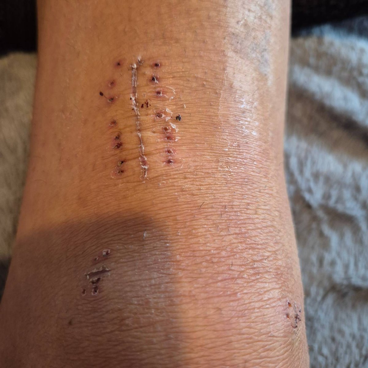 New knee, new me for sure 🦵😂⚽️