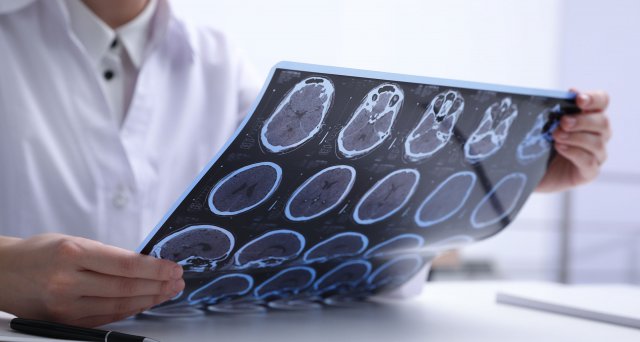 Long COVID: 7-Tesla-MRT weist auf entzündliche Veränderungen im Hirnstamm hin:  Cambridge – Britische Forscher haben mit einer speziellen Bildgebung, die in einer Magnetresonanztomografie (MRT) nur mit leistungsstarken Geräten möglich ist, bei… dlvr.it/TF9BcY