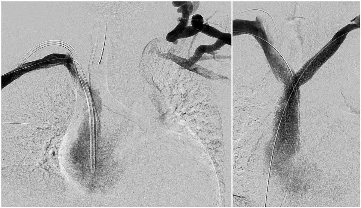 Jeffrey F. B. Chick, MD, MPH (@chickvir) on Twitter photo In patients with dysfunctional arteriovenous accesses, 51% have a history of central venous catheters, and 26% have thoracic central vein obstruction. Reconstruction with dedicated venous stents may restore accesses for these patients.
<a href="/SIRspecialists/">Society of Interventional Radiology</a> <a href="/CVIR_Journal/">CVIR Journal</a> <a href="/cvirendo/">CVIR Endovascular (Jim Reekers, Editor-in-Chief)</a> In patients with dysfunctional arteriovenous accesses, 51% have a history of central venous catheters, and 26% have thoracic central vein obstruction. Reconstruction with dedicated venous stents may restore accesses for these patients.
<a href="/SIRspecialists/">Society of Interventional Radiology</a> <a href="/CVIR_Journal/">CVIR Journal</a> <a href="/cvirendo/">CVIR Endovascular (Jim Reekers, Editor-in-Chief)</a>