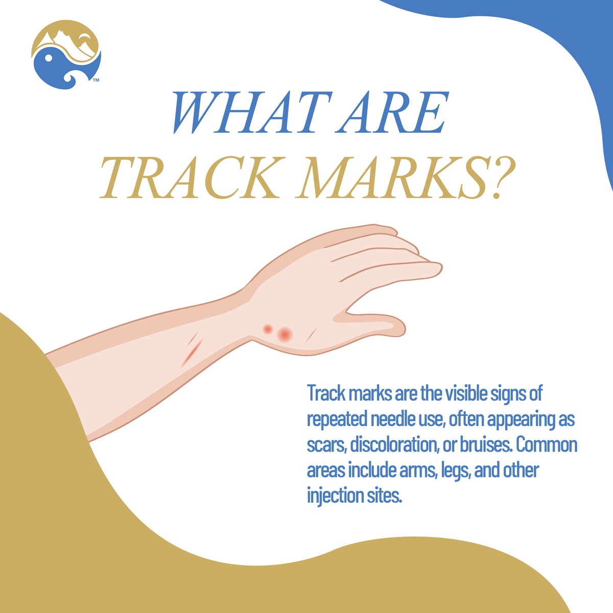 AsanaRecovery's tweet photo. Swipe through these tips to learn how you can support your skin’s recovery while staying strong on your path to sobriety. From moisturizing to lifestyle changes, every small step helps. 🌱💧

#TrackMarks #RecoveryJourney #Healing #StayStrong #AddictionRecovery #SkinCare #Support https://t.co/br1zzXMFMP