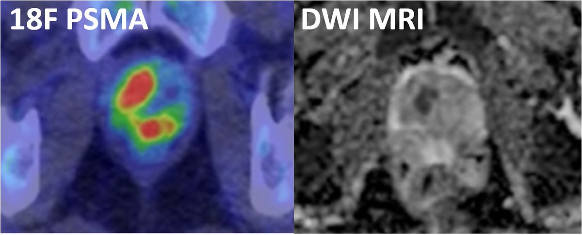 Alastair Lamb (@lambalastair) on Twitter photo Delighted to share our latest on #18F_PSMA_PET just published in cool new <a href="/JUOpenPlus/">JU Open Plus</a>!
•n=1335 scans from 1220 men
•1°: PSMA 96% vs MRI 89% sens. for pros lesions at RP
•2°: PSA 0.2-0.49 post RP/RT ➡️ avidity in 57.8%
BUT high false +ves (esp ribs)
journals.lww.com/juop/fulltext/… Delighted to share our latest on #18F_PSMA_PET just published in cool new <a href="/JUOpenPlus/">JU Open Plus</a>!
•n=1335 scans from 1220 men
•1°: PSMA 96% vs MRI 89% sens. for pros lesions at RP
•2°: PSA 0.2-0.49 post RP/RT ➡️ avidity in 57.8%
BUT high false +ves (esp ribs)
journals.lww.com/juop/fulltext/…