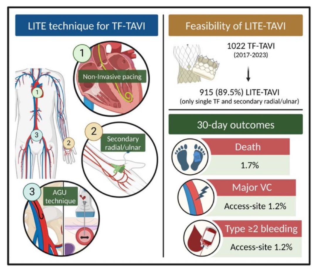 Francesco Bianchini (@bianchinifra92) on Twitter photo JUST OUT the results of systematic adoption of our LITE TAVI technique!!!
Thx to <a href="/BURZOTTA_F/">FRANCESCO BURZOTTA</a> , carlo trani, enrico romagnoli, <a href="/CristinaAuri17/">Cristina Aurigemma</a> and all the coauthors.
<a href="/IJC_Heart_Vasc/">International Journal of Cardiology Heart&Vasc</a>
authors.elsevier.com/sd/article/S23… JUST OUT the results of systematic adoption of our LITE TAVI technique!!!
Thx to <a href="/BURZOTTA_F/">FRANCESCO BURZOTTA</a> , carlo trani, enrico romagnoli, <a href="/CristinaAuri17/">Cristina Aurigemma</a> and all the coauthors.
<a href="/IJC_Heart_Vasc/">International Journal of Cardiology Heart&Vasc</a>
authors.elsevier.com/sd/article/S23…