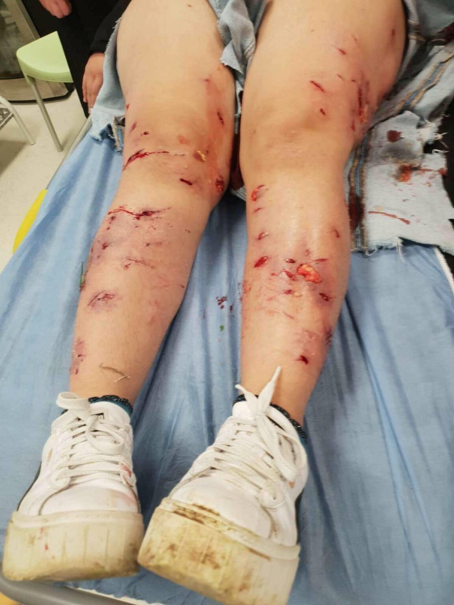 VrojtuesitPR's tweet photo. Gjendja e vajzes e cila u kafshua para pak casteve nga qent endacak ne hyrje te QKUK.  A duhet te vdese dikush qe institucionet te mirren me kete problem? https://t.co/rgV9AVUSgg