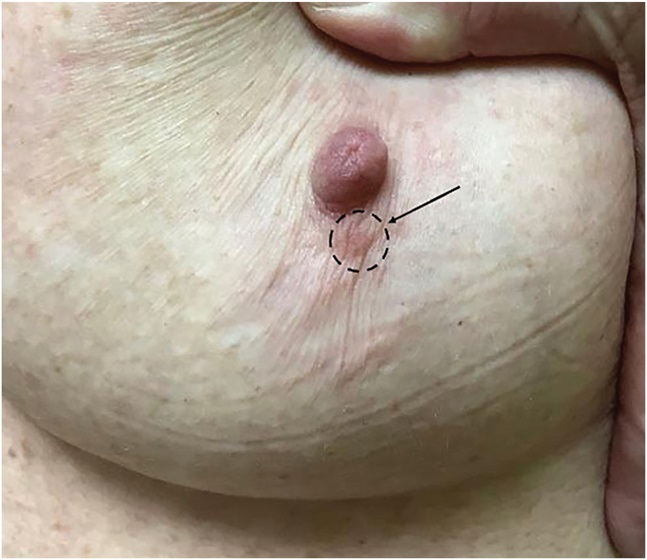 AJDP_Journal's tweet photo. #ClinicalPathologicChallenge
60F with a strong family history of breast cancer presented with erythematous papule without surface change on the inferior aspect of the left areola
IHC: (A) CK7, (B) Her-2
What is your diagnosis?
Any additional stains you'd like to perform? https://t.co/5hOjQVCWHm