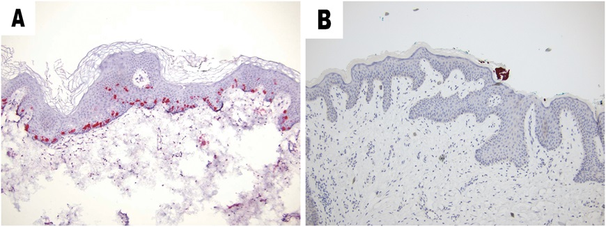 AJDP_Journal's tweet photo. #ClinicalPathologicChallenge
60F with a strong family history of breast cancer presented with erythematous papule without surface change on the inferior aspect of the left areola
IHC: (A) CK7, (B) Her-2
What is your diagnosis?
Any additional stains you'd like to perform? https://t.co/5hOjQVCWHm
