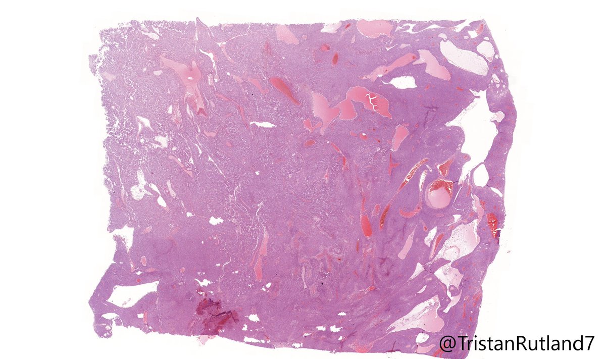 TristanRutland7's tweet photo. Sigmoid colon

#GIpath #BSTpath #pathresident #Pathtwitter https://t.co/ZY0nNCD1oY