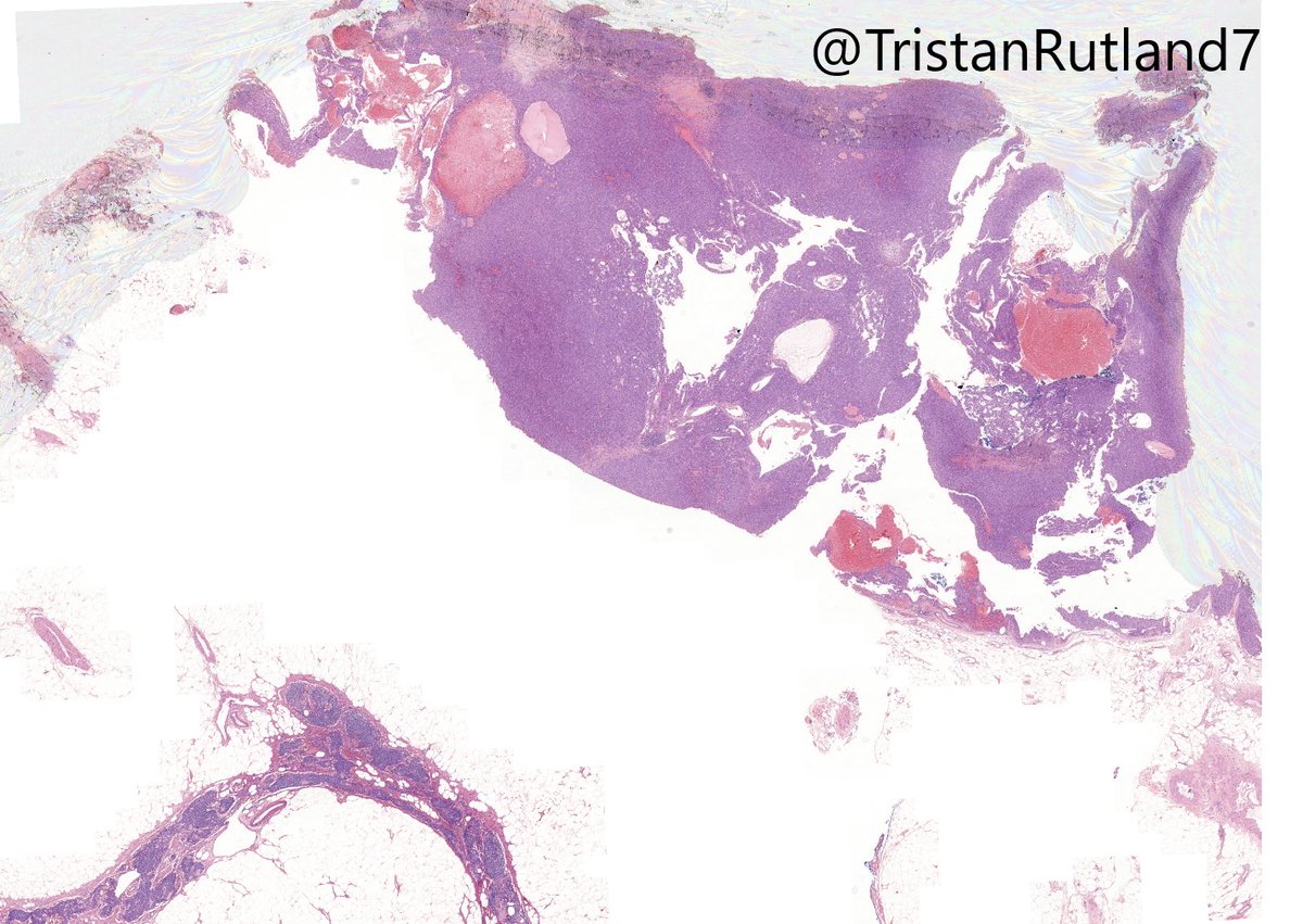 TristanRutland7's tweet photo. Sigmoid colon

#GIpath #BSTpath #pathresident #Pathtwitter https://t.co/ZY0nNCD1oY