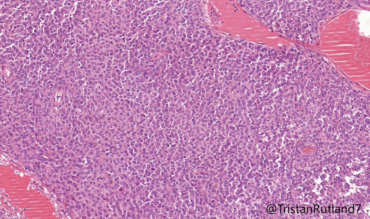 TristanRutland7's tweet photo. Sigmoid colon

#GIpath #BSTpath #pathresident #Pathtwitter https://t.co/ZY0nNCD1oY