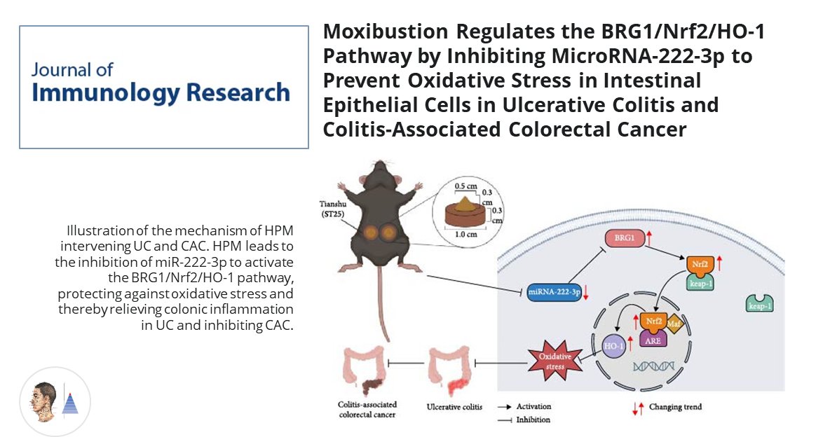 🐀Acupuncture expérimentale 🇨🇳
📰J Immunol Res
Modèles de colite ulcéreuse et de cancer colorectal associé [souris]. Effets antioxydants et anti-inflammatoires de la moxibustion 𝑣𝑖𝑎 ↘ des microARN-222-3p et ↗ la voie BRG1/Nrf2/HO-1.

pubmed.ncbi.nlm.nih.gov/39359694/🔓