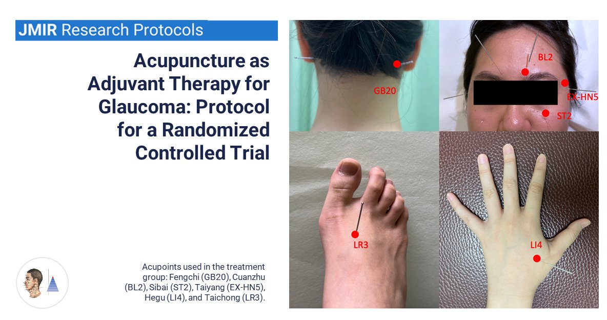 🔀Essai contrôlé randomisé 🇹🇼
📰JMIR Res Protoc
#Glaucome. Protocole d’un essai évaluant l’acupuncture [A] comme traitement adjuvant 𝑣𝑒𝑟𝑠𝑢𝑠 fausse [A]. Évaluation sur la pression oculaire avant et après chaque séance (n=6) et  à trois mois.

pubmed.ncbi.nlm.nih.gov/39378079/ 🔓