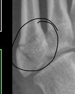 No NYC marathon this year - rolled my ankle for the thousandth time but this time my foot hurt rather than my ankle… appreciate the great service at NYU orthopedic urgent care! ⁦<a href="/nyulangone/">NYU Langone Health</a>⁩ ⁦⁦<a href="/nyugrossman/">NYU Grossman School of Medicine</a>⁩