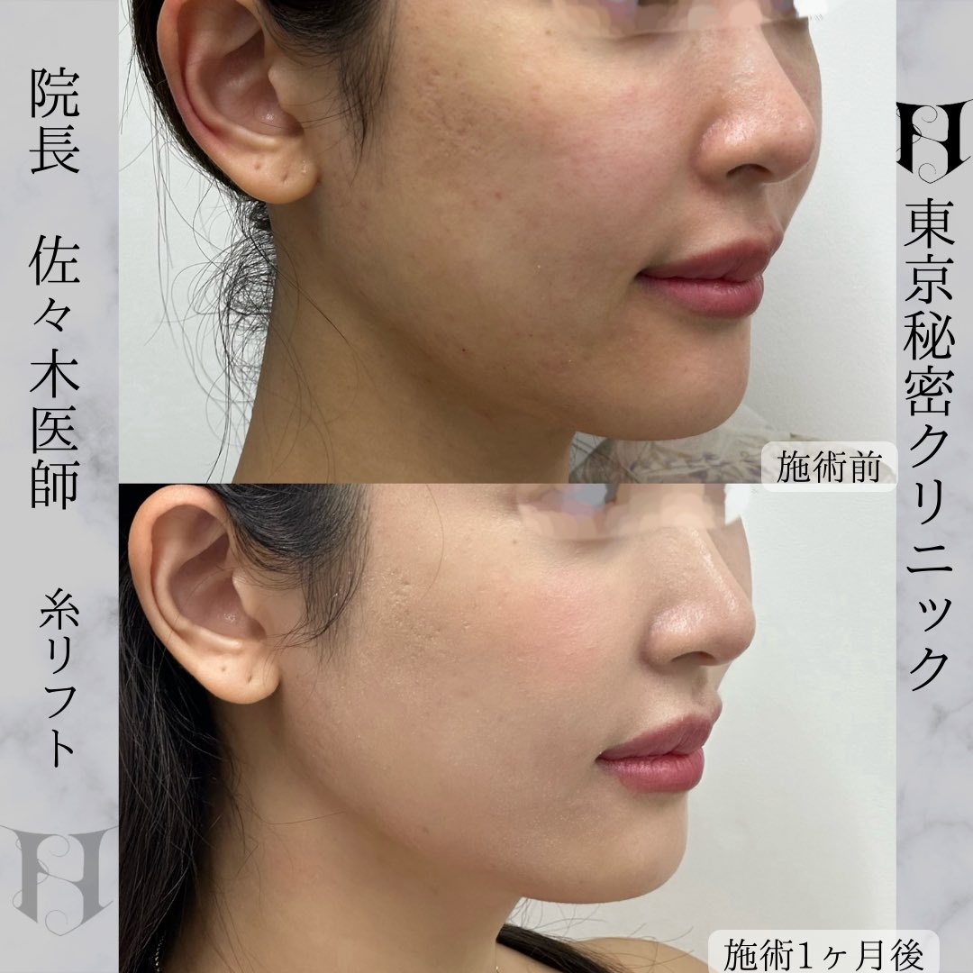 la_clref_clinic's tweet photo. 東京秘密クリニック佐々木健一郎による糸リフトで小顔に
糸リフトは入れる角度や挿入部位がとても大事！ほうれい線や口横のもたつきが他院でやっても変わらないという方は当院まで
#糸リフトなら佐々木健一郎#糸リフトなら東京秘密クリニック#小顔治療#ほうれい線#口横のもたつき#たるみ治療#糸リフト https://t.co/2rXEE1Jb0J