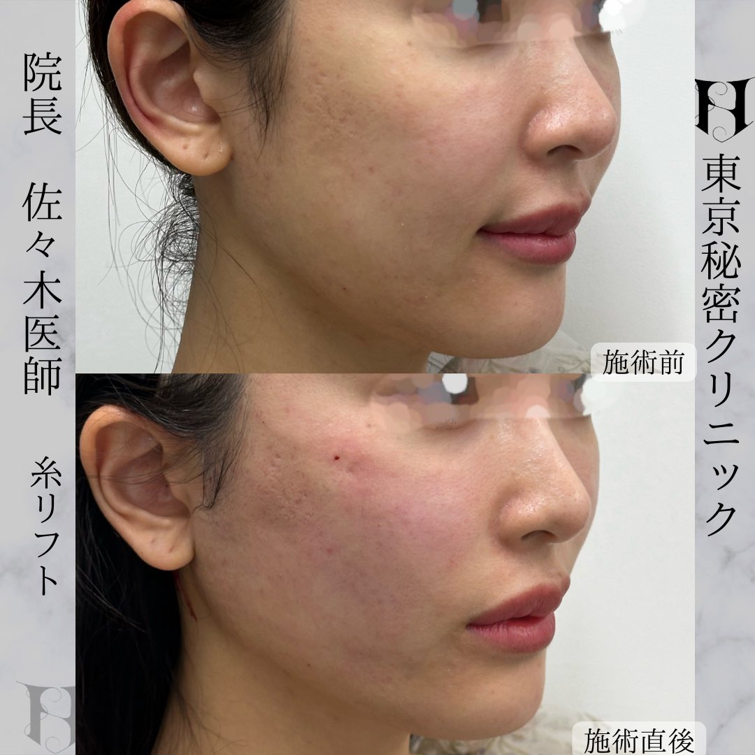 la_clref_clinic's tweet photo. 東京秘密クリニック佐々木健一郎による糸リフトで小顔に
糸リフトは入れる角度や挿入部位がとても大事！ほうれい線や口横のもたつきが他院でやっても変わらないという方は当院まで
#糸リフトなら佐々木健一郎#糸リフトなら東京秘密クリニック#小顔治療#ほうれい線#口横のもたつき#たるみ治療#糸リフト https://t.co/2rXEE1Jb0J