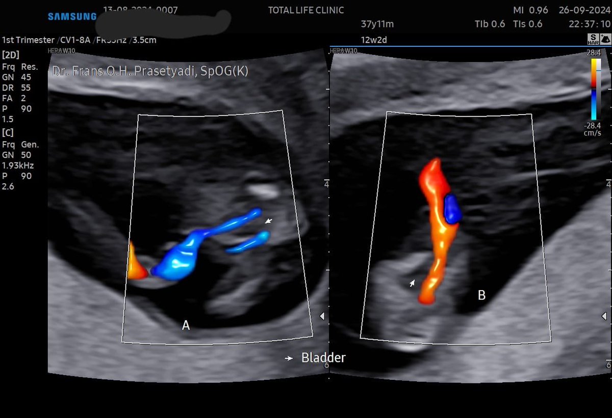 frans_ohp's tweet photo. Just posting…some ultrasound images of a possible sFGR at first trimester https://t.co/yU1EhTgXfx