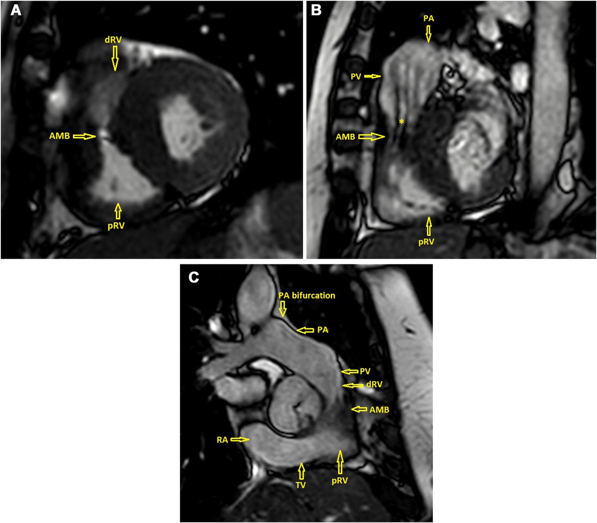 Intāl Society for Adult Congenital Heart Diseaseš (@isachd) on Twitter photo This <a href="/ISACHD/">Intāl Society for Adult Congenital Heart Diseaseš</a> #CaseOfTheMonth is a 67-year-old with a history of ascending aortic #aneurysm, mixed aortic valve disease, presenting with a syncopal event. She was found to have a #double-chambered #right #ventricle with no known history of a ventricular septal defect. This <a href="/ISACHD/">Intāl Society for Adult Congenital Heart Diseaseš</a> #CaseOfTheMonth is a 67-year-old with a history of ascending aortic #aneurysm, mixed aortic valve disease, presenting with a syncopal event. She was found to have a #double-chambered #right #ventricle with no known history of a ventricular septal defect.