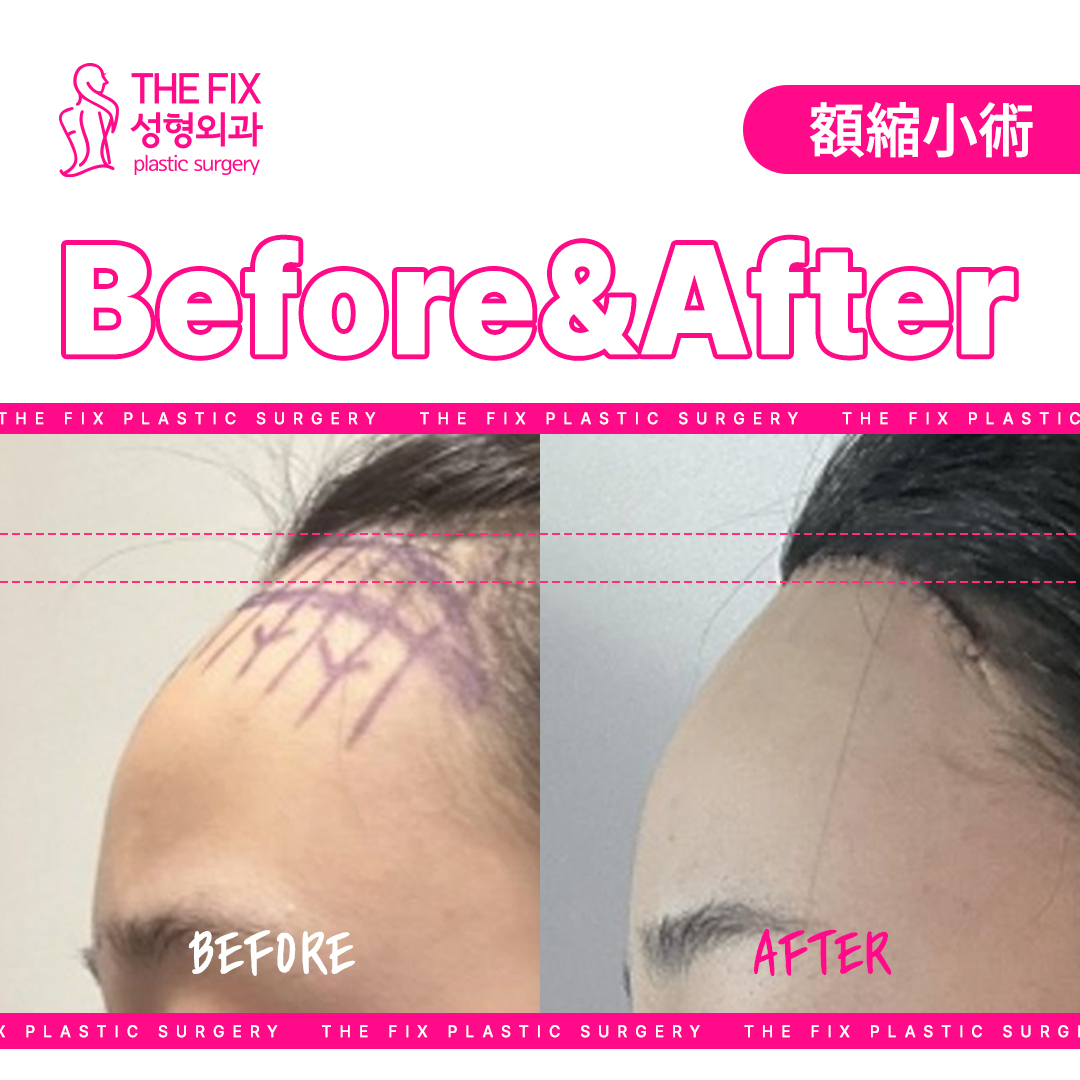 thefixps's tweet photo. 【別人級の変化⁉️】

少ないダウンタイム+短い施術時間の額縮小手術でこんなにも変化が出ちゃいます😧🤍

額縮小手術で顔の比率を整えて垢抜けちゃいませんか❔

#額縮小 #額リフト #ヘアライン矯正 #切開リフト #フェイスリフト #韓国整形 #韓国美容 https://t.co/bTvTRt2pV5