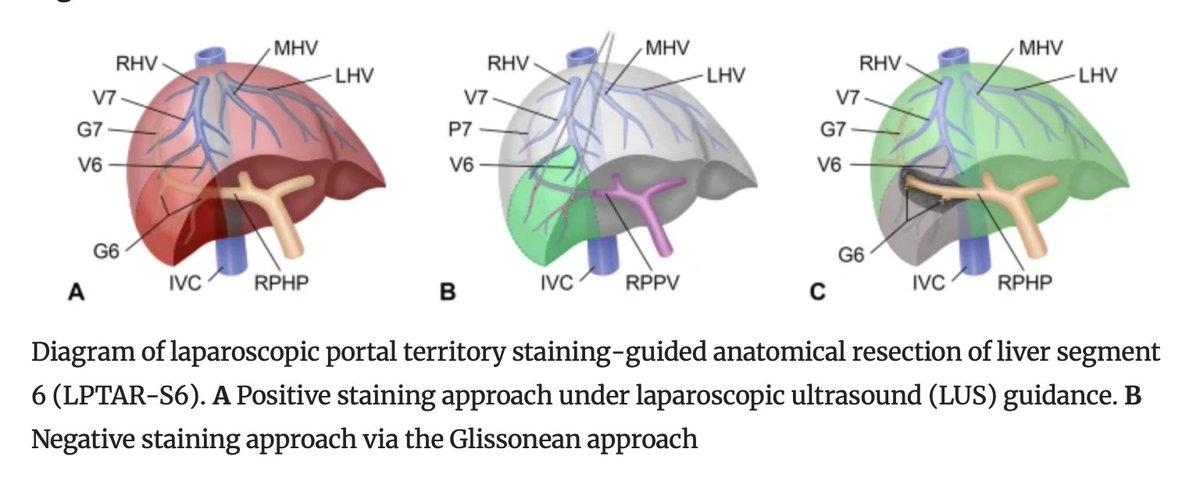 Annals of Surgical Oncology (@annsurgoncol) on Twitter photo October Issue: #IndocyanineGreen Fluorescence-Guided Laparoscopic Anatomical #Segmentectomy of Liver Segment 6: Surgical Strategy and Technical Details
rdcu.be/dWuJh
<a href="/CamilleLStewart/">Camille Stewart, MD</a>
<a href="/SyedAAhmad5/">Syed A. Ahmad</a> October Issue: #IndocyanineGreen Fluorescence-Guided Laparoscopic Anatomical #Segmentectomy of Liver Segment 6: Surgical Strategy and Technical Details
rdcu.be/dWuJh
<a href="/CamilleLStewart/">Camille Stewart, MD</a>
<a href="/SyedAAhmad5/">Syed A. Ahmad</a>
