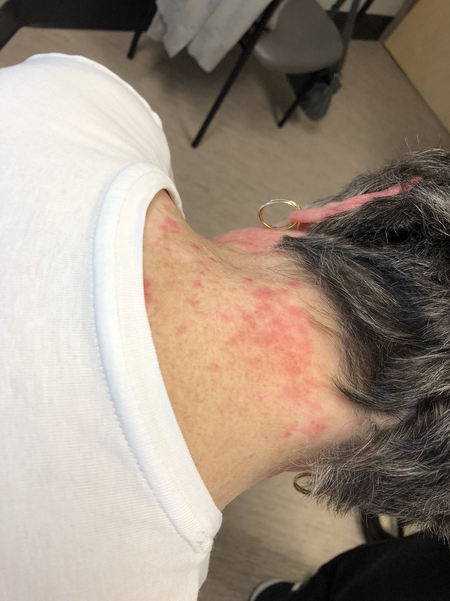 Janetbirdope's tweet photo. #ClinicalPearl
#Photosensitive #rash
What is the #diagnosis?
be precise!
What is the MOST likely + #autoantibody
#Diagnosis in 4 #pictures
#Dermatology #MedX #MedEd #RheumX #RheumX https://t.co/dscOiPML2B